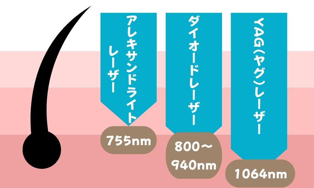 医療脱毛 レーザー 種類